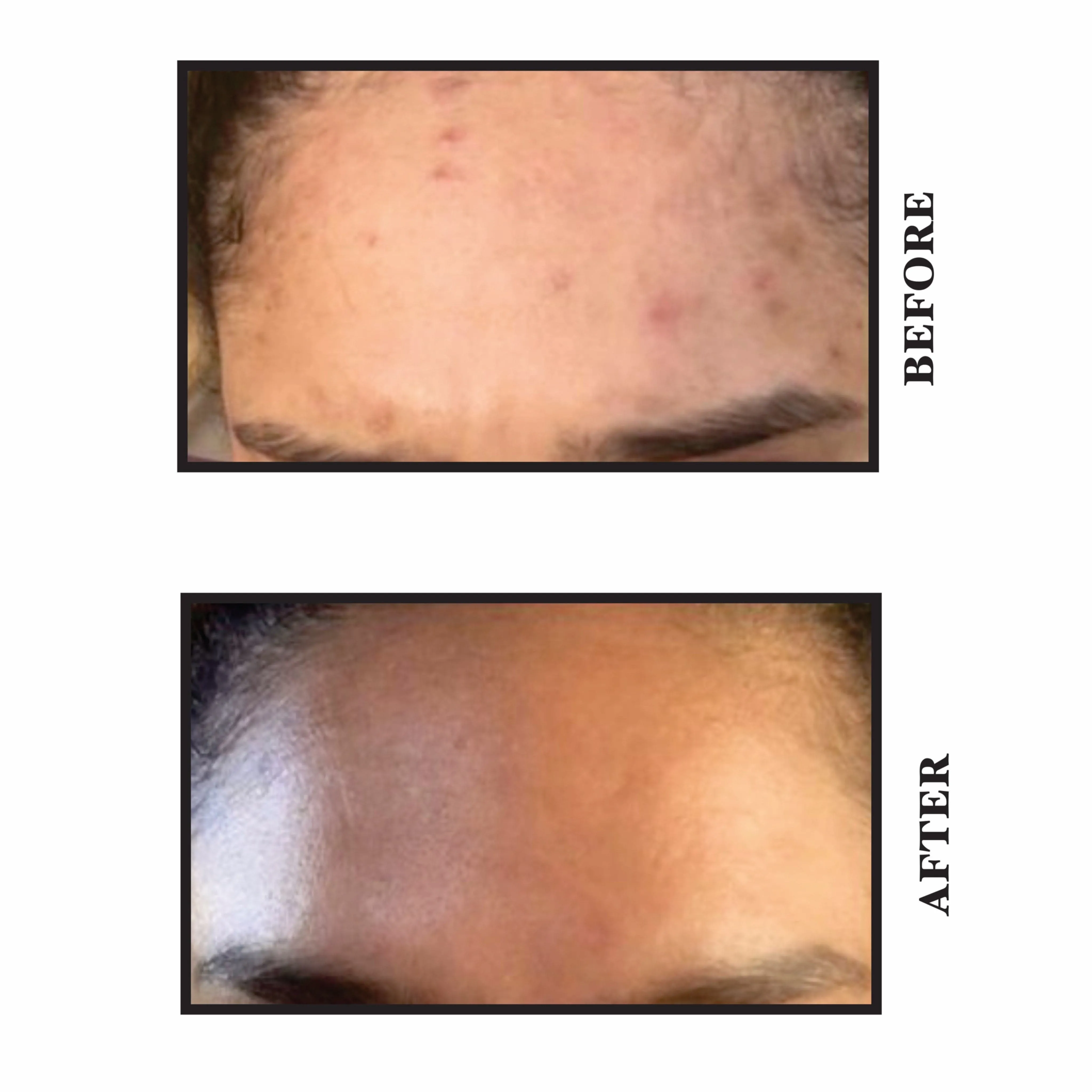 Acne and Oil Control Serum | 30ml
