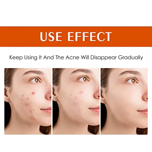 Acne Treatment for Face, Salicylic Acid Acne Cream Back Acne Treatment Cream