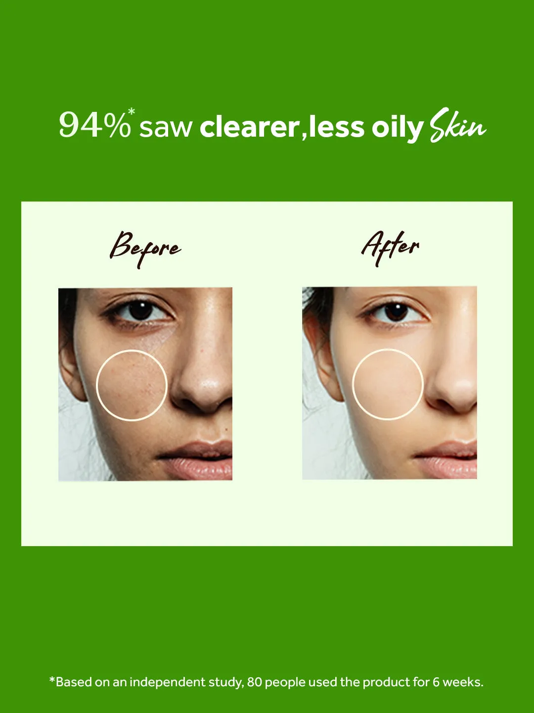 atulya Tea Tree  Anti acne Facial Mist Toner (Add 2 Products in the Cart & Get 1 Free Product Use Code: B1G1)