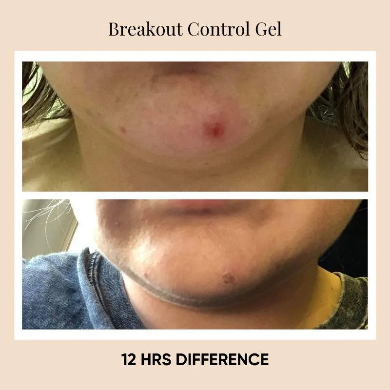 Breakout Control Gel