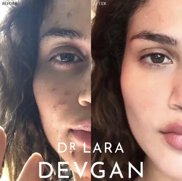 Dr. Lara Devgan Retinol   Bakuchiol Serum 2.5x