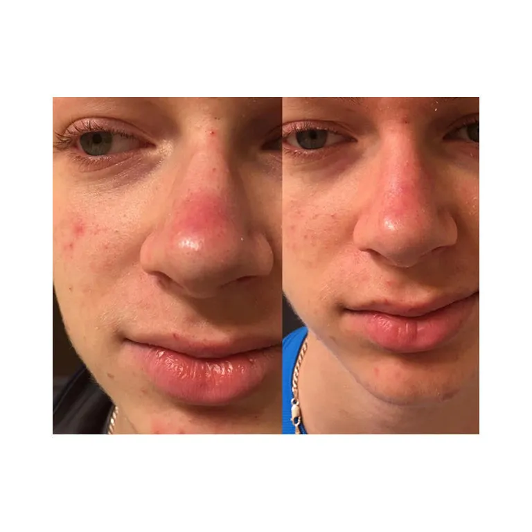 Dual Acne Serum | 1 fl oz