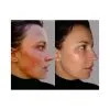 Dual Acne Serum | 1 fl oz