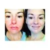 Dual Acne Serum | 1 fl oz
