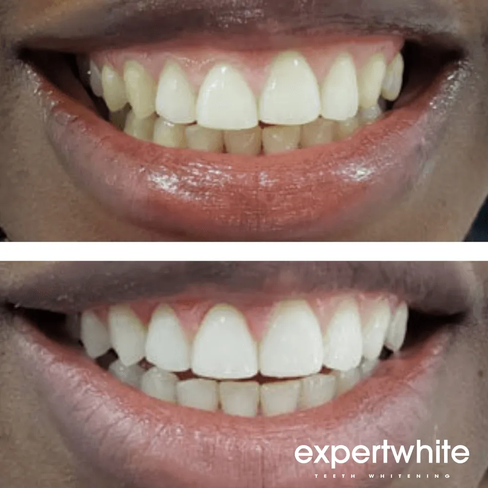 Expertwhite Max Pro-Whitening Precision Kit