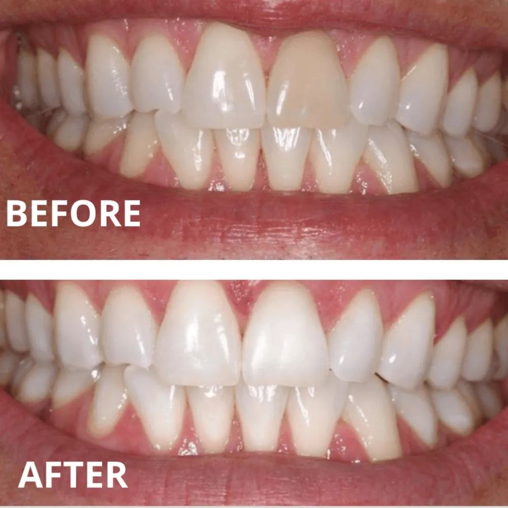 Expertwhite Max Pro-Whitening Precision Kit