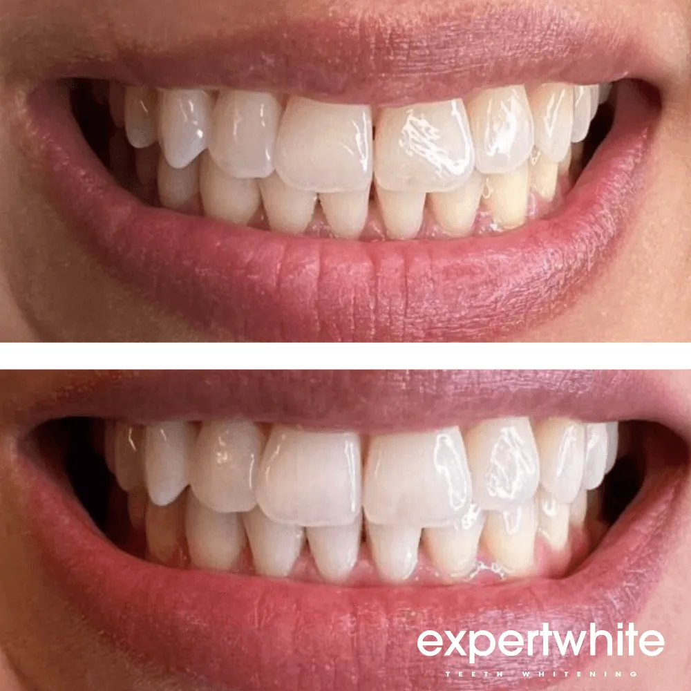 Expertwhite Max Pro-Whitening Precision Kit