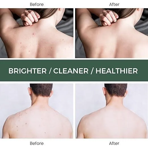 Jaysuing Back Acne Treatment Spray - 120ml