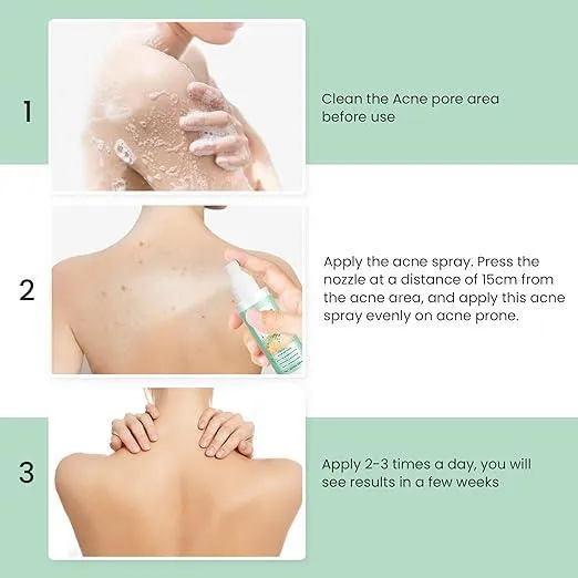 Jaysuing Back Acne Treatment Spray - 120ml