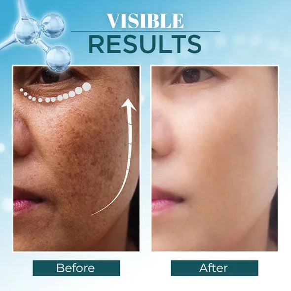 LANTHOME™ Dark Spot Corrector Remover