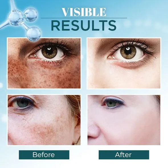 LANTHOME™ Dark Spot Corrector Remover