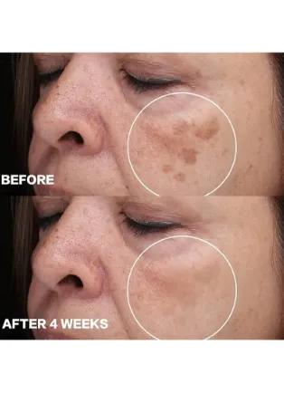 NEW Dark Spot Remover for Face, Dark Spot Corrector, Face Melasma Treatment, Hyperpigmentation Treatment, Freckle Remover with Niacinamide, Arbutin and Vitamin C/E/B5 1.7 fl oz, Cream