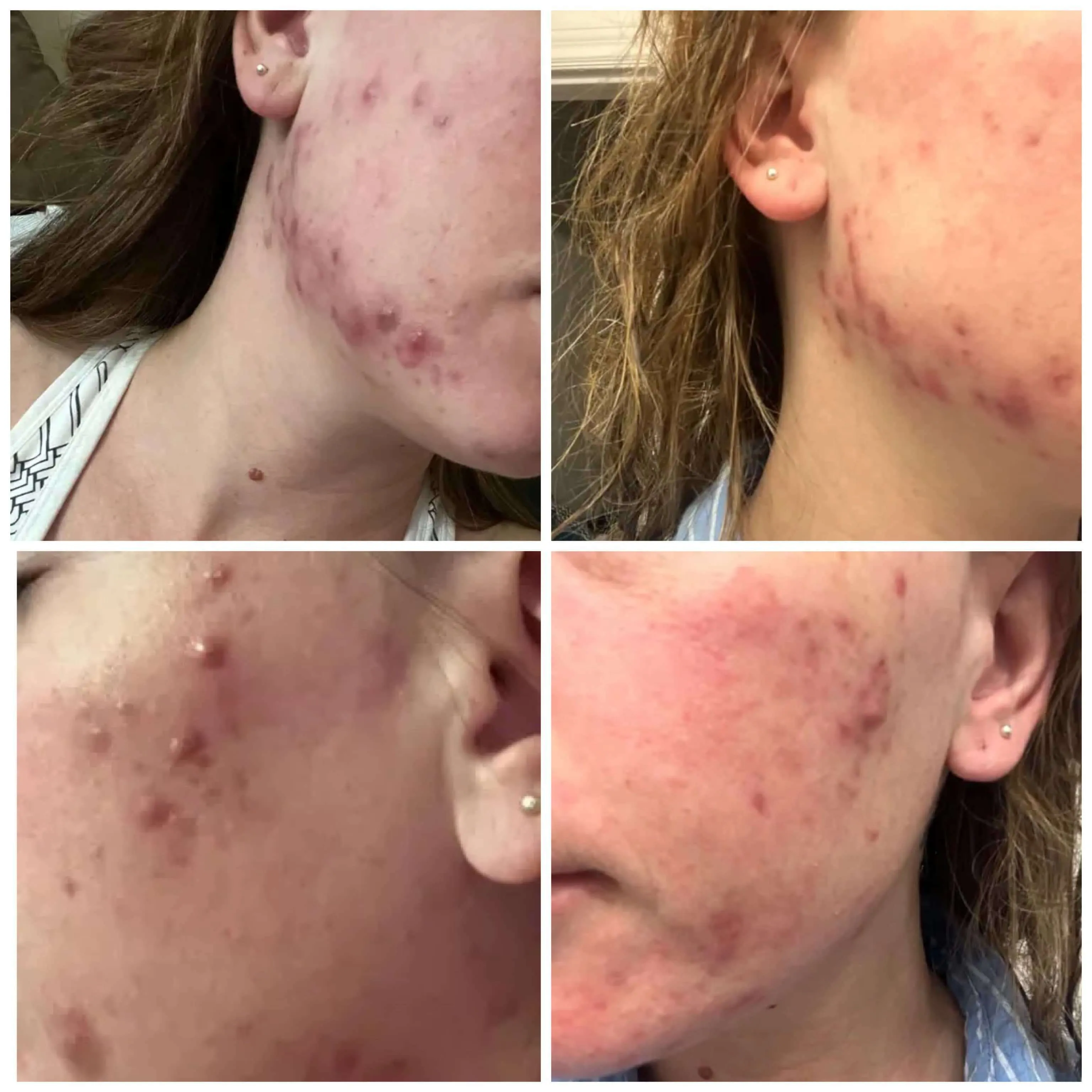 Pregnancy Acne Treatment Kit
