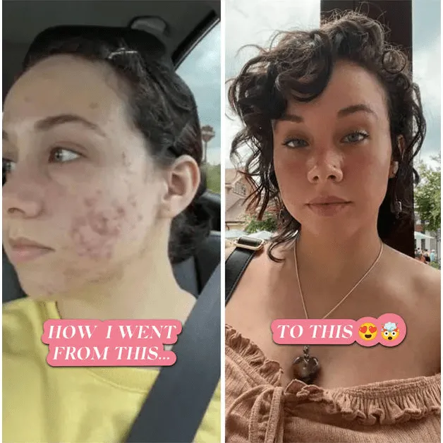 Pregnancy Acne Treatment Kit