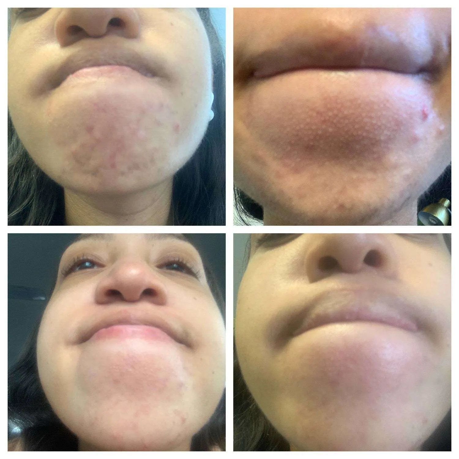 Pregnancy Acne Treatment Kit