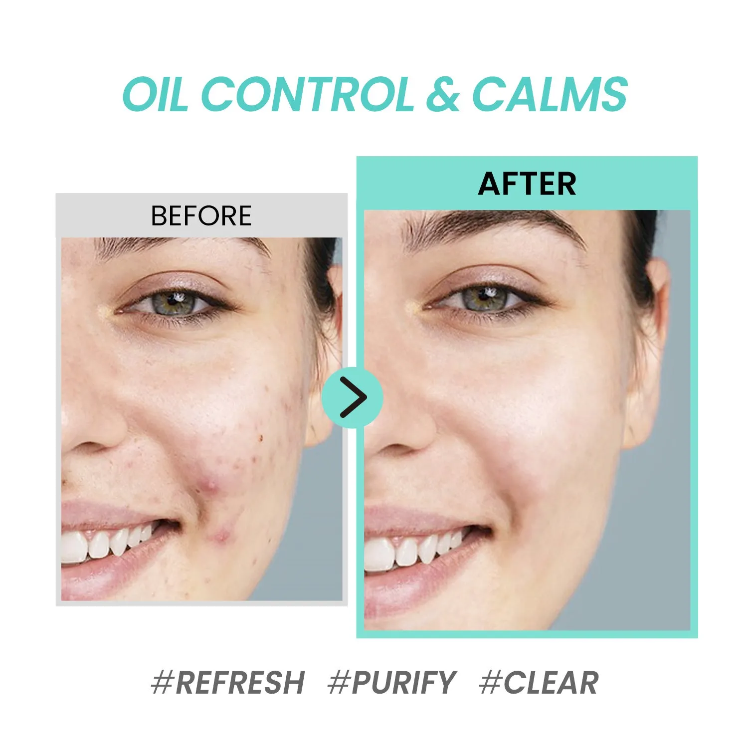Tea Tree Pore & Sebum Emulsion