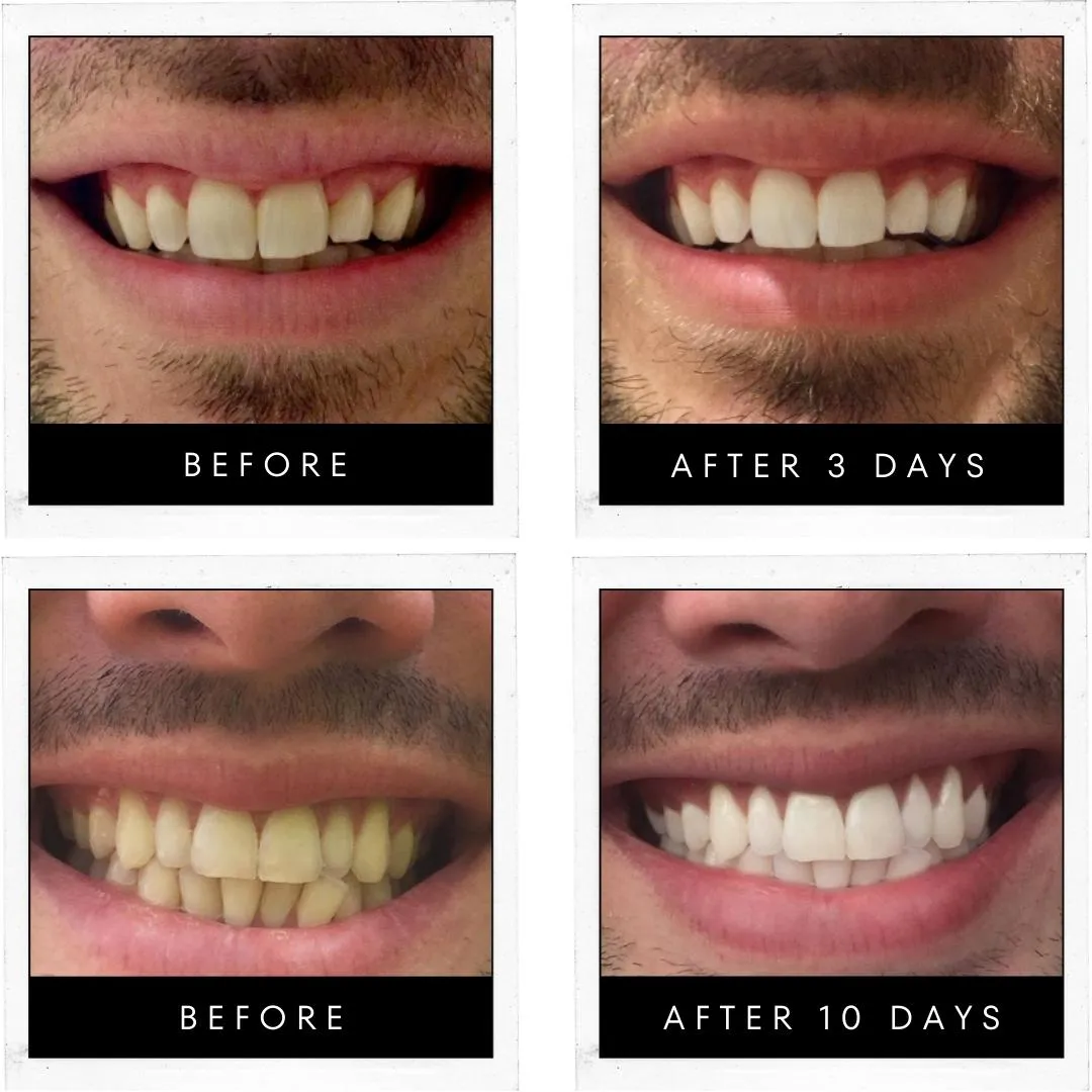 Whiter Smile Whitening Kit (Made In USA)